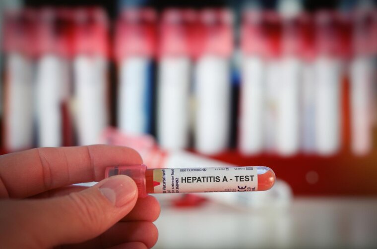 Zagonetni porast slučajeva hepatitisa u djece